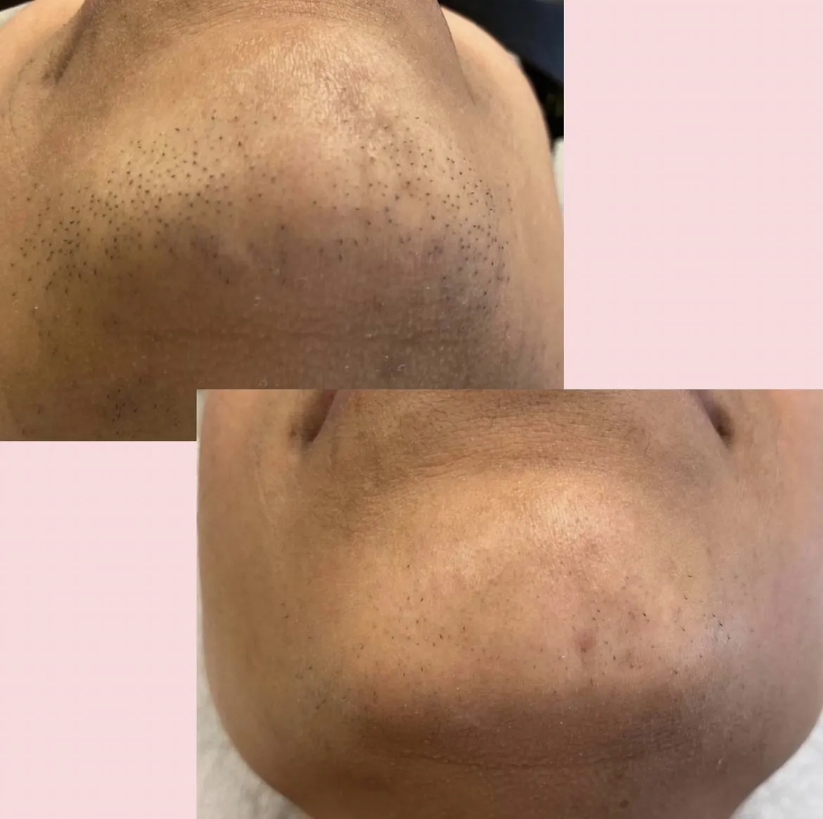 Permanent hårborttagning i Stockholm hos Lean Laser