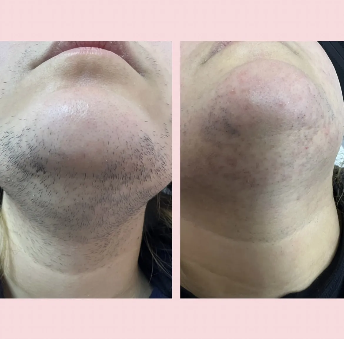 Permanent hårborttagning med laser i Stockholm, före och efter
