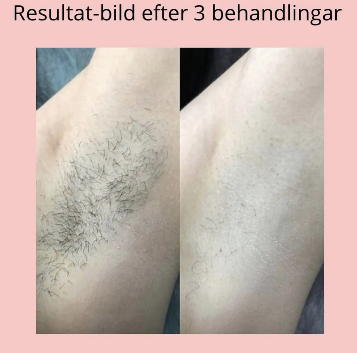 Hårborttagning resultat efter 3 behandlingar i Stockholm av Lean Laser
